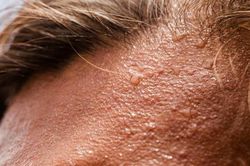 6 hiểu lầm phổ biến về chứng tăng tiết mồ hôi