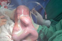 Bình Phước: Bé gái chào đời trong 'bọc điều' hiếm gặp