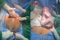 Bé gái chào đời trong 'bọc điều' hiếm gặp