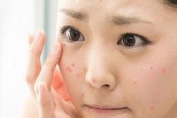 Mùa hè ăn gì để da khỏe đẹp, tránh nổi mụn?