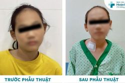 Điều trị vẹo cổ cho một bệnh nhi