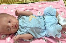 Sự sống mong manh của bé trai 2 tháng tuổi bị não úng thủy và dị tật hậu môn