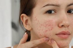 Nguyên nhân khiến da mụn mãi không khỏi