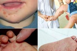 Thông tin mới nhất về bệnh tay chân miệng ở nước ta, 6 khuyến cáo cần nhớ của Bộ Y tế