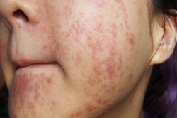 Mụn chi chít vì thói quen tưởng chừng như vô hại