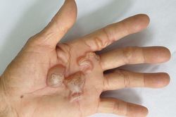 Nhiễm ký sinh trùng từ động vật nuôi trong nhà