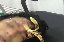 Cứu sống bệnh nhân bị bông cửa sắt hàng rào cắm chặt vào hộp sọ