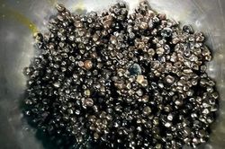 Cụ bà 73 tuổi có hàng nghìn viên sỏi trong túi mật
