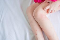 Nên làm gì để loại bỏ các vết thâm do côn trùng cắn?