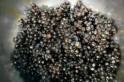 Hàng nghìn viên sỏi trong túi mật bệnh nhân 73 tuổi
