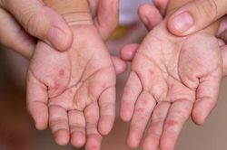 Có thể trị tay chân miệng tại nhà an toàn, tránh biến chứng?