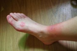 Nhập viện cấp cứu vì vết côn trùng đốt ở chân