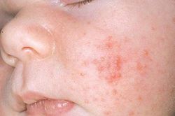 Mụn trứng cá ở trẻ sơ sinh, nhũ nhi: Nguyên nhân và phương pháp điều trị