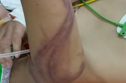 Tắm biển nếu bị sứa đốt thì làm ngay điều này để phòng nguy hiểm