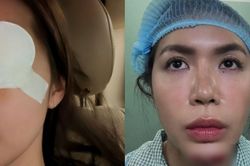 Minh Tú tiếp tục gặp vấn đề sức khỏe sau sự cố phải khâu 10 mũi ở cằm