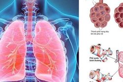 Ai dễ mắc viêm phổi, cần làm gì để chóng hồi phục?