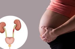 Nhận biết dấu hiệu viêm đường tiết niệu ở mẹ bầu để điều trị sớm, ngừa biến chứng