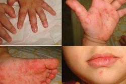 6.000 chai thuốc Immunoglobulin cung ứng cho các bệnh viện để điều trị bệnh nhân mắc tay chân miệng