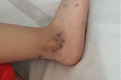 Bình Dương kiểm soát bệnh tay chân miệng ra sao?