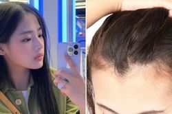 Cắt da đầu, đục lỗ chân tóc để xinh đẹp giống thần tượng Hàn Quốc