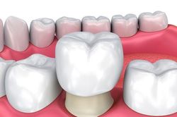 8 mối nguy từ việc bọc răng sứ không đảm bảo chất lượng