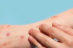 Thái Lan: Số ca mắc đậu mùa khỉ tăng mạnh trong tháng Sáu