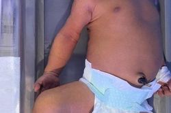 Bất đồng nhóm máu với mẹ, bé sơ sinh mắc bệnh não cấp phải thay máu toàn phần