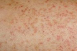 Mắc sốt xuất huyết hết sốt đã khỏi bệnh chưa?