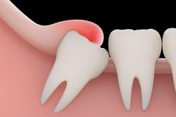Khi nào cần nhổ răng khôn?