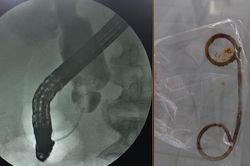 Nam bệnh nhân bỏ quên stent trong đường mật suốt 2 năm
