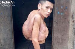 Chàng trai đáng thương 'cõng' khối u 'khổng lồ' suốt hơn 20 năm
