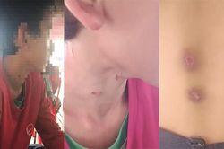 An Giang: Một bé trai 14 tuổi nghi bị bố dượng bạo hành dã man