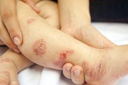 Con nứt da đầu, bong tróc toàn bộ da mặt vì sai lầm nhiều cha mẹ gặp phải
