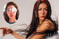 Minh Tú lại gặp sự cố ở mắt sau tai nạn phải may 10 mũi tại cằm
