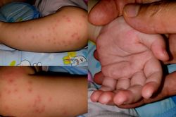 TP.HCM nguy cơ thiếu thuốc điều trị bệnh tay chân miệng