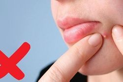 4 thói xấu khiến da bùng phát mụn