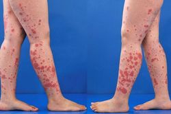 Cách chữa bệnh viêm mao mạch dị ứng