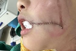 Liên tục cấp cứu người lớn, trẻ em vỡ xương hàm, gãy răng do tai nạn thang máy