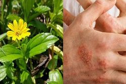 3 cách dùng sài đất giảm triệu chứng viêm da cơ địa