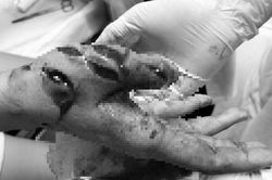 Máy xay đa năng nghiến đứt gân tay thiếu nữ