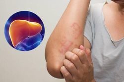 Có một trong những dấu hiệu này, có thể bệnh gan đã đi vào giai đoạn nặng trên cơ thể bạn