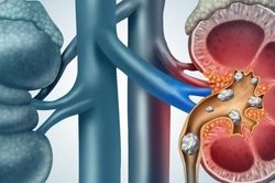 Sỏi thận: Nguyên nhân, dấu hiệu và cách điều trị
