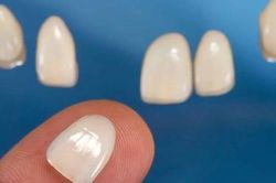 8 nhược điểm của dán sứ veneer và cách khắc phục