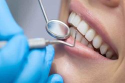 Lưu ý trước và sau khi dán sứ veneer