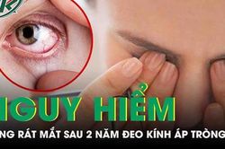 Mắt cô gái 'khô như bà lão' do đeo kính áp tròng