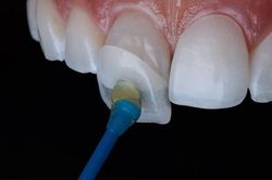5 hệ lụy khi thực hiện dán sứ veneer sai kỹ thuật
