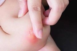 Cách giảm ngứa tức thì khi bị muỗi đốt, tiếc là đã không biết sớm hơn