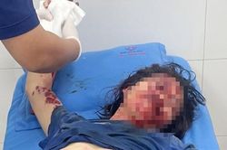 Nổ điện thoại, một phụ nữ bị thương nặng, chấn thương mặt