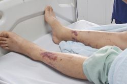 Nhiễm liên cầu khuẩn sau khi ăn lòng lợn luộc chín