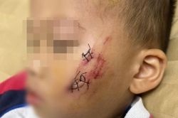 Bé trai 2 tuổi bị chó nghi dại cắn rách má